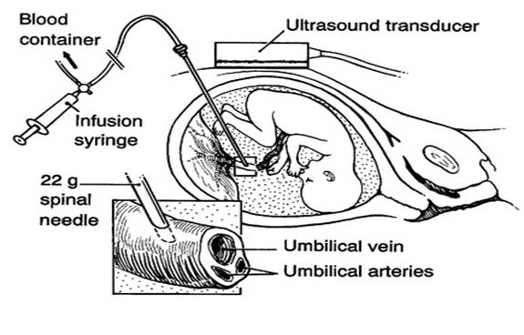 intrauterine transfusion